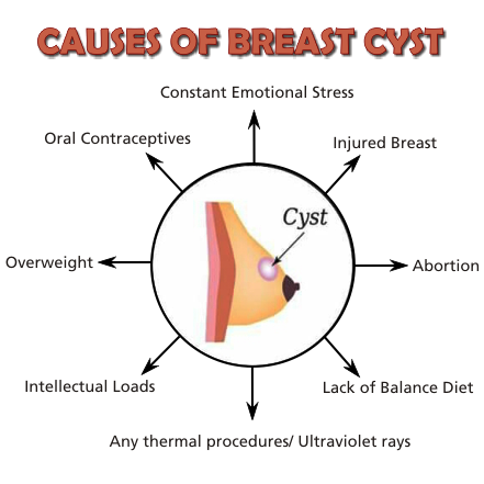 Causes of Breast Cyst for Precautionary Measures